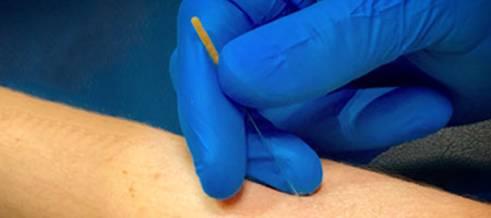 physical therapist performing trigger point dry needling treatment